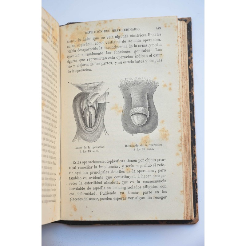 La esterilidad humana y el hermafrodismo