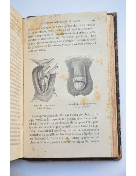 La esterilidad humana y el hermafrodismo