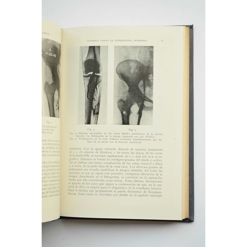 Trombosis venosa y embolia pulmonar