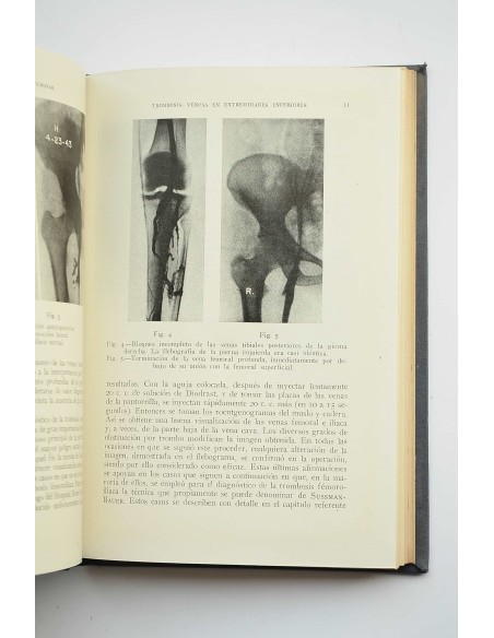 Trombosis venosa y embolia pulmonar