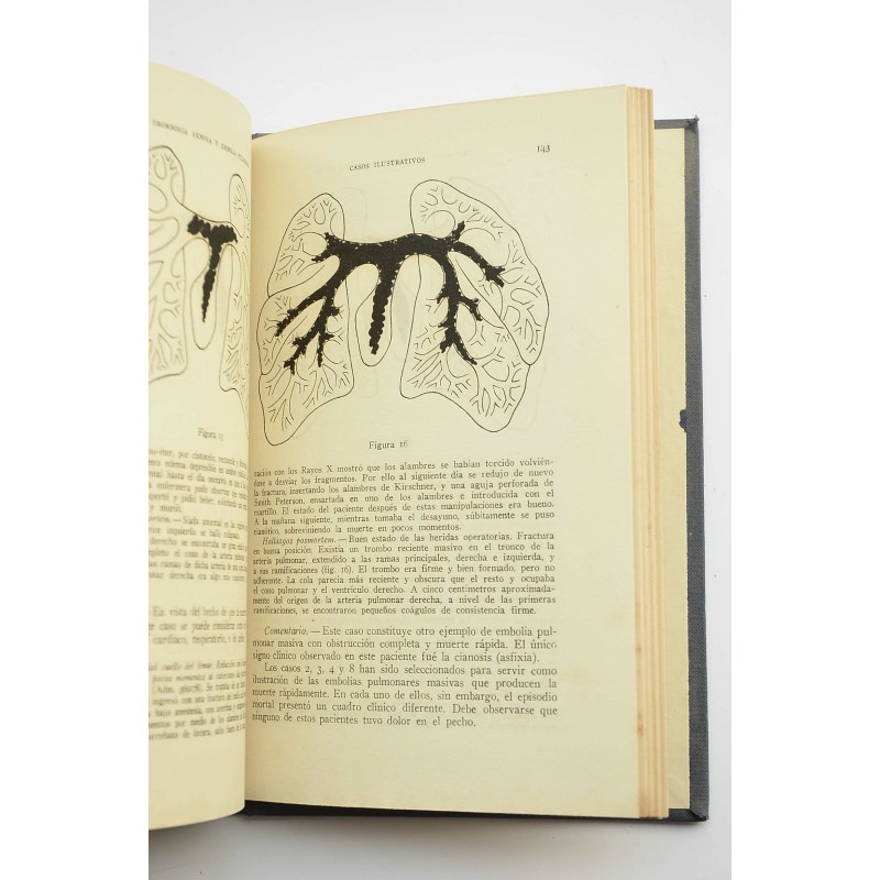 Trombosis venosa y embolia pulmonar