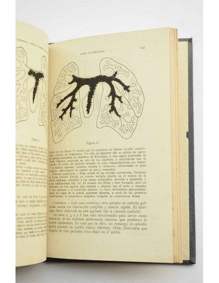 Trombosis venosa y embolia pulmonar