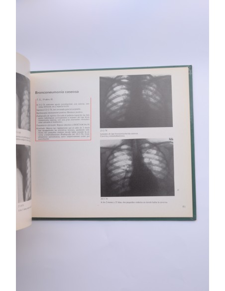Isoetam. Primera molécula bi - tuberculostática